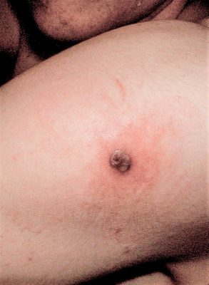 Öffentliche Impfung