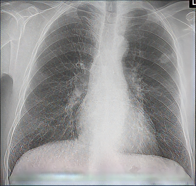 Röntgenbild einer Lunge
